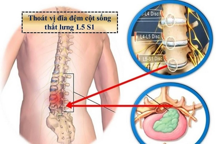 Thoát vị đĩa đệm L5 - S1 gây đau lưng dưới